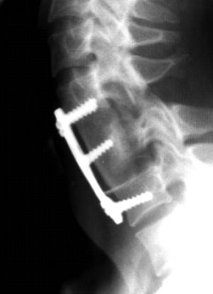 Рис.8б Рентгенограмма шейного отдела позвоночника в боковой проекции. Титановая пластина фиксирует С4 и С6 позвонки. Средний винт фиксирует межтеловой аутотрансплантат из подвздошной кости.